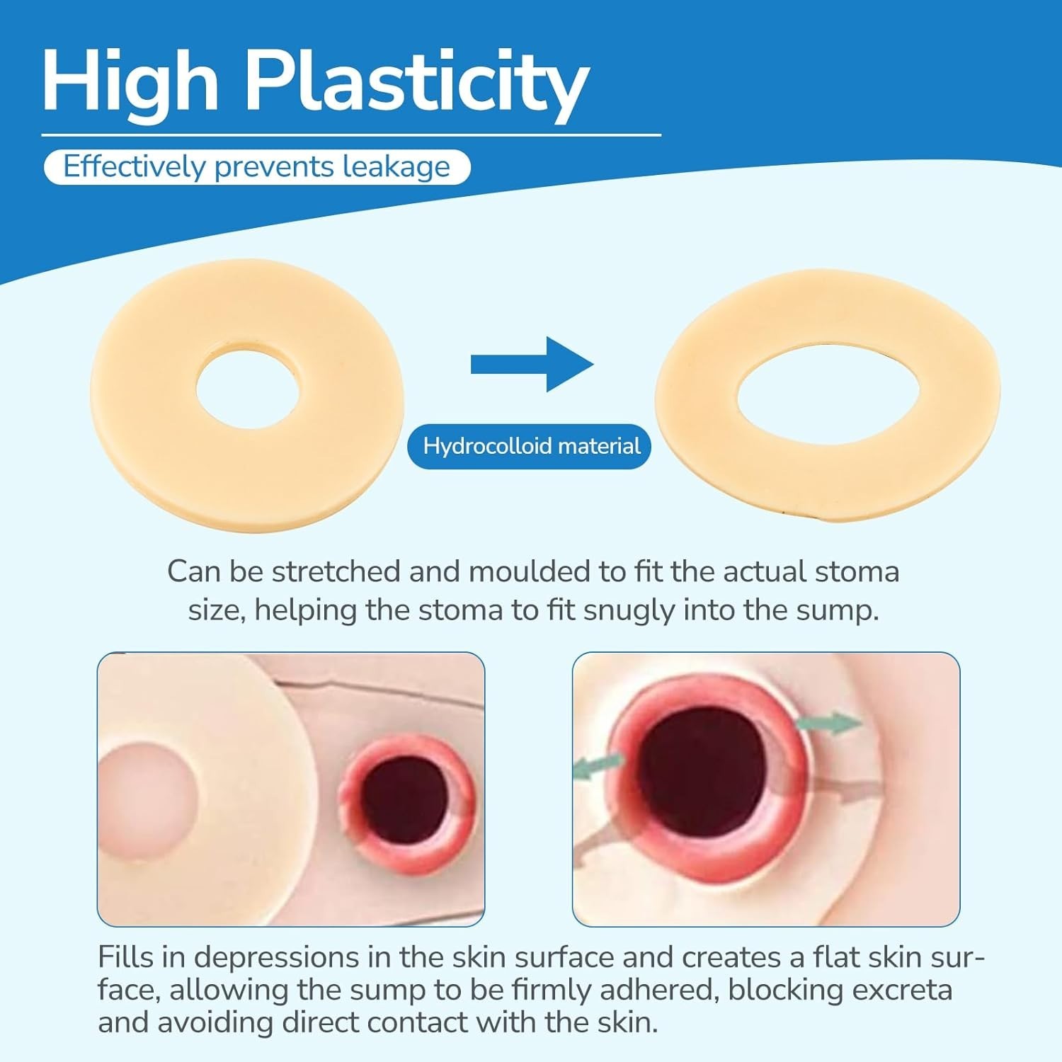 30 PCS Protective Ostomy Seal Rings 2mm – Moldable Hydrocolloid Barrier Seals