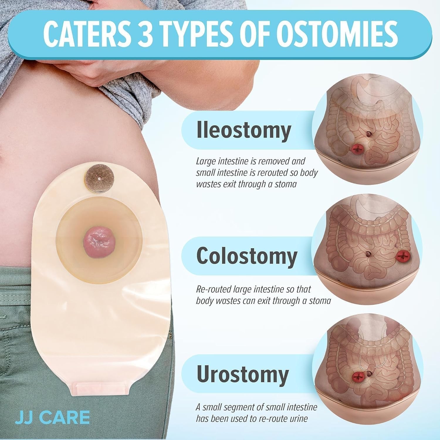 Colostomy Bags 20 PCS, One-Piece Pouching Ostomy Bags, No Mess Ostomy Supplies f